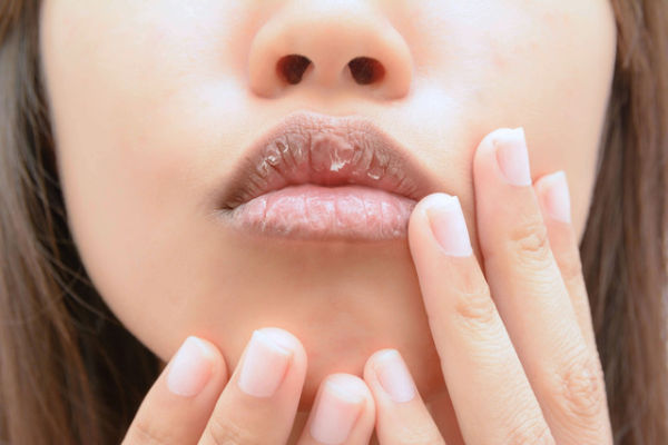 Ilustrasi bibir hitam dan kering. Foto: Mr.Cheangchai Noojuntuk/Shutterstock