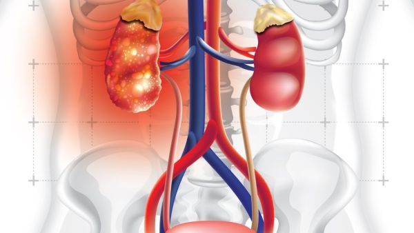 How does kidney stones become? Know 5 domestic habits that can become the reason
