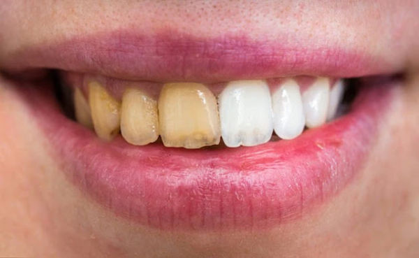 Expert told that a panacea for cleaning yellow teeth, do TRAI every night in a few days