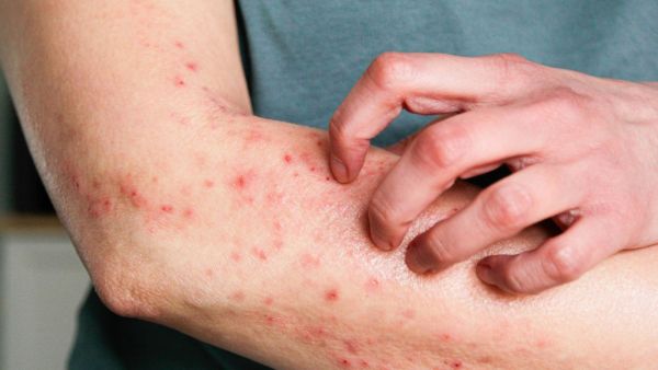 Woman became brain dead due to mosquito bites? This was the reason