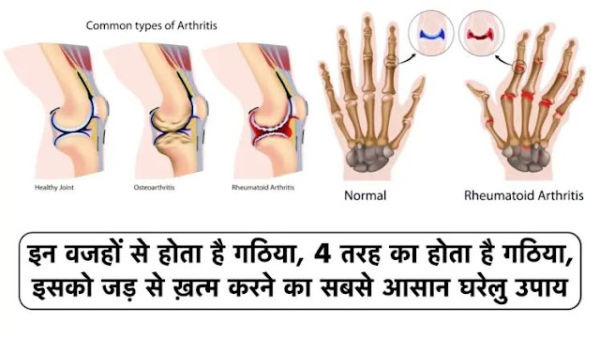 Due to these reasons, arthritis occurs, there are 4 types of arthritis, the easiest domestic tips to eliminate it from the root ..