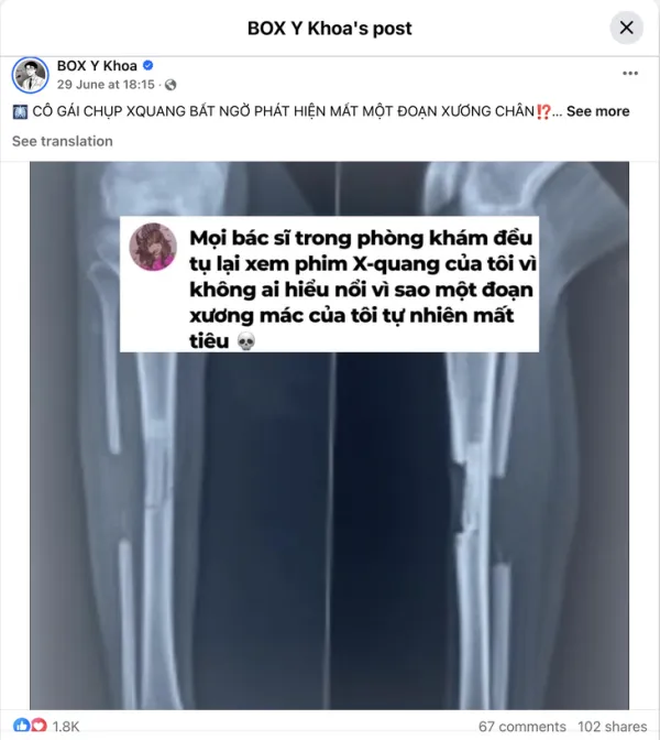 Cô gái chụp X-quang bất ngờ thấy mất xương chân - Ảnh 1. chụp X-quang - Ảnh 1.