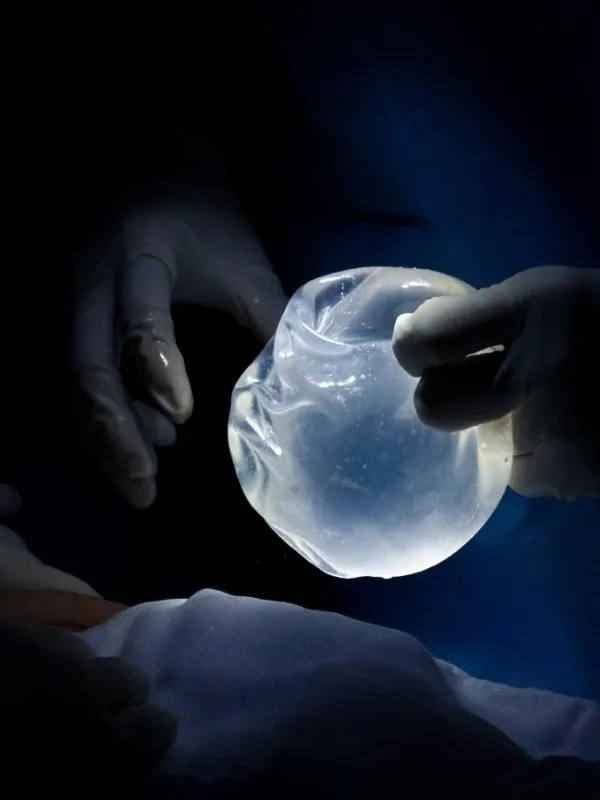Implant folding inside the pocket after 8 years. Photo courtesy of Dr. Ho Cao Vu