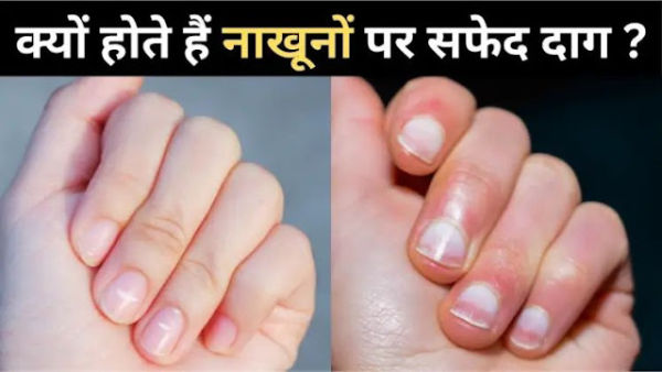 What are white stains on your nails too? Know the reason here