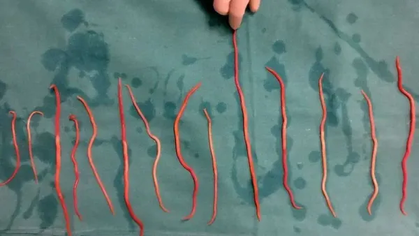 Cacing gelang di tubuh seorang wanita dari India.