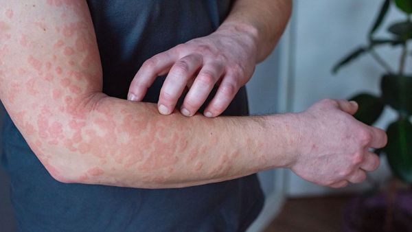 If fungal infection is done in the rain, what symptoms are seen?