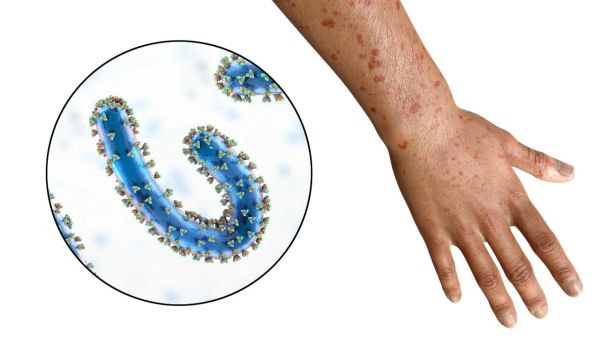 Many skin diseases can occur due to water accumulation during rainy season
