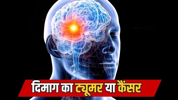Is every brain tumor with cancer? Learn from experts Is every brain tumor with cancer? Learn from experts