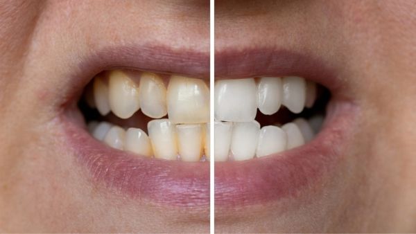 Yellow teeth will also be clean for years, adopt these 5 easy ways