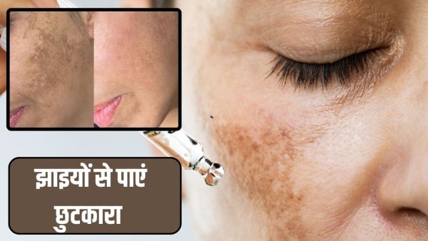 These domestic things will help reduce the freckles, just use it like this