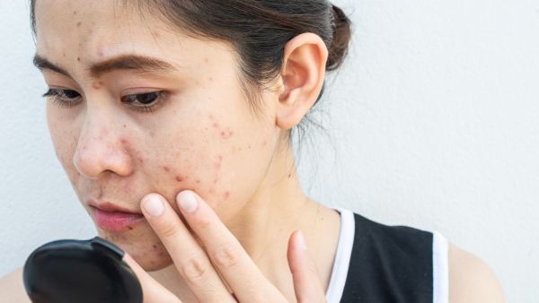 Why do rash leaves on the face again and again? How to rescue?