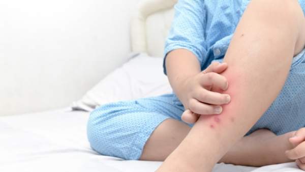Ilustrasi kulit kering pada anak. Foto: Thinkstock