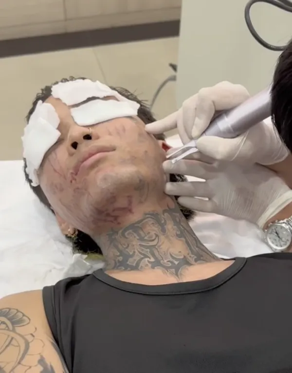 Truong Hanh Phuc during the tattoo removal process. Photo courtesy of Phuc