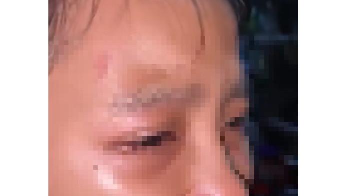 KORBAN - Seorang anak di bawah umur di Kota Denpasar, yang diduga dianaya oleh kekasih ayah kandungnya berinisial KI.