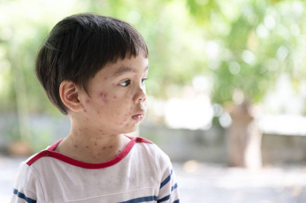 Ilustrasi Anak Kena Cacar Air. Foto: Shutterstock
