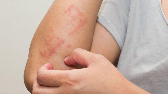 ilustrasi kulit gatal yang sering terjadi pada musim hujan, berikut ini penjelasan dokter kulit mengenai masalah kulit yang sering terjadi di musim hujan