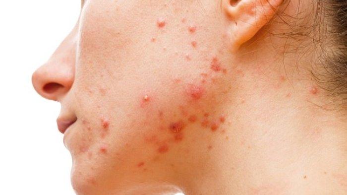 ilustrasi seseorang yang alami breakout saat musim hujan, berikut ini penjelasan dokter kulit mengenai masalah kulit yang sering terjadi di musim hujan