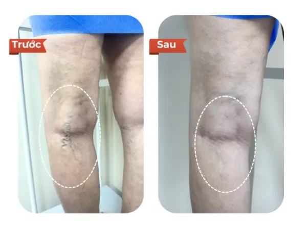 With the disappearance of large varicose veins, the unevenness in the calf has significantly improved. Photo courtesy of Dr.Vein