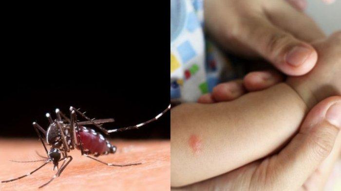 ilustrasi anak yang mengalami demam berdarah