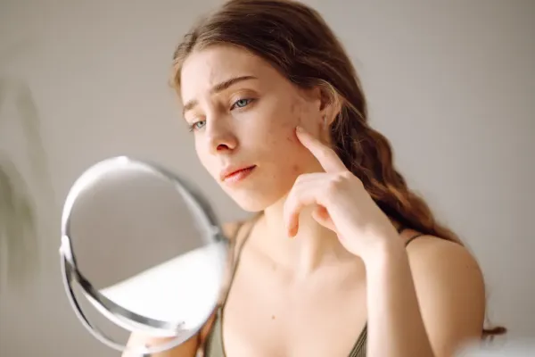 Young woman with acne on her face looking in a mirror.