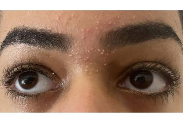 Beauty Tips: Get Rid Of Red Rashes After Eyebrow Plucking