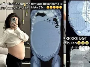 Viral Wanita Surabaya Idap Kista Sebesar 33 Cm, Inikah Pemicunya?
