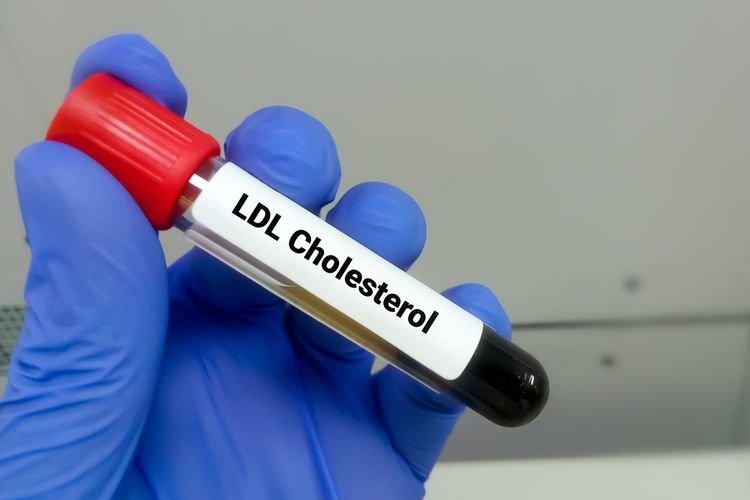 ilustrasi kadar kolesterol jahat yang terlalu tinggi di dalam tubuh