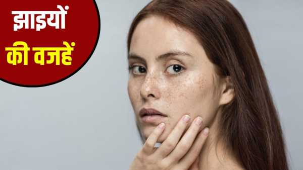 Why do freckles appear on the skin? What is its treatment, know from the expert