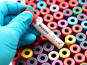 Kenali Gejala Campak, Dialami Selebgram Ruce Nuenda yang Viral Keluyuran saat Sakit