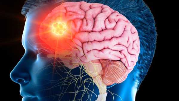 Why does brain stroke occur? What is the first thing to do after seeing its symptoms?