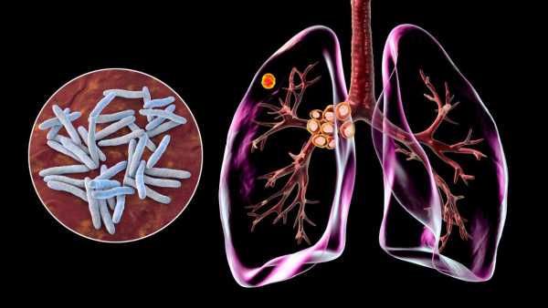 World TB day: When does a normal cough become TB? Know the symptoms and reasons for delay in identification