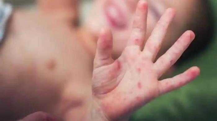 CAMPAK PADA ANAK - Ilustrasi campak pada anak. Dinas Kesehatan Kabupaten Klaten menetapkan status Kejadian Luar Biasa (KLB) campak setelah ditemukan dua anak terpapar virus tersebut. Penetapan status KLB ini menjadi langkah cepat pemerintah daerah untuk mencegah penyebaran penyakit menular di wilayah tersebut.