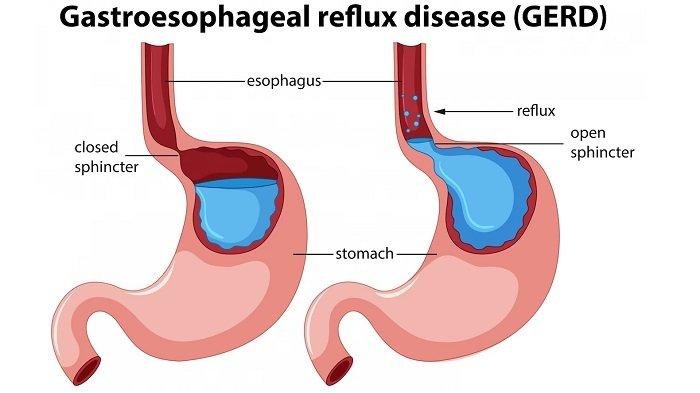 ilustrasi GERD