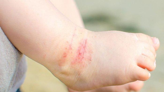 Ilustrasi dermatitis atopik