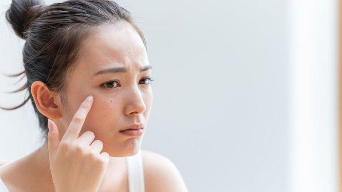 MASALAH KULIT - Seorang remaja tampak dengan jerawat di wajahnya, memperlihatkan kondisi kulit yang rentan saat musim hujan. Kelembapan tinggi membuat jerawat mudah kambuh, menjadi salah satu masalah kulit yang paling sering muncul di musim hujan.