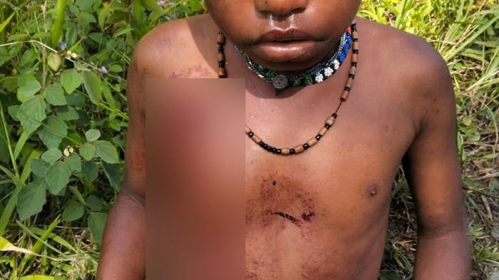 OPERASI MILITER DI PAPUA - Anak kecil berinisial PW (5) yang terkena peluru di bagian dadanya di Kabupaten Puncak dalam peristiwa tragis yang terjadi pada Senin, 14 April 2026, sekitar pukul 05.00 WIT. 8 orang dilaporkan meninggal dunia dan Para Walia masih dalam perawatan. (warga)