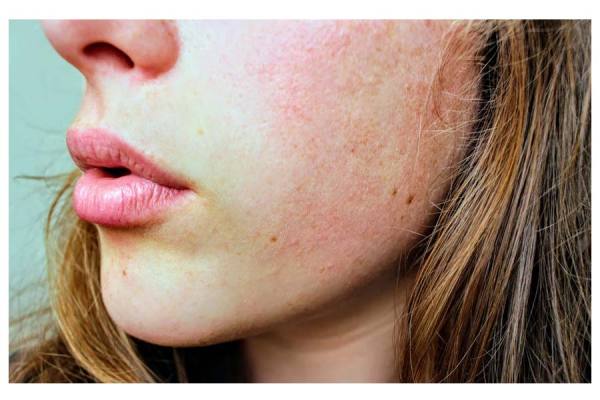 Expert tips for dry skin even after moisturizing