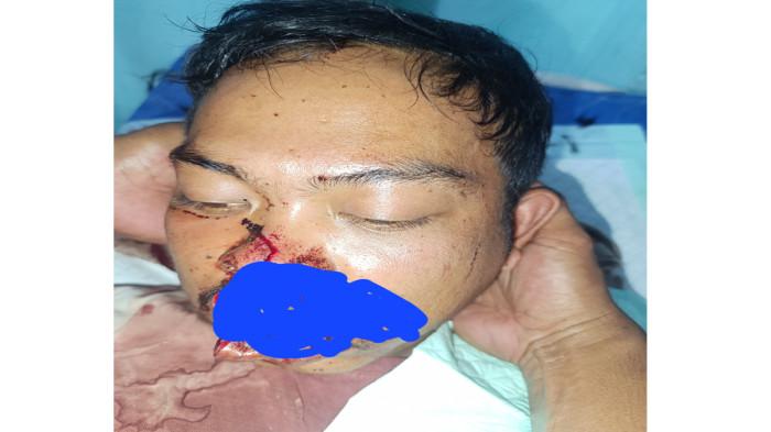 DITERKAM HARIMAU - Roni (26), warga Dusun Ayu Ara, Desa Singah Mulo, Kecamatan Putri Betung, yang menjadi korban terkaman Harimau Saat berada di kebun