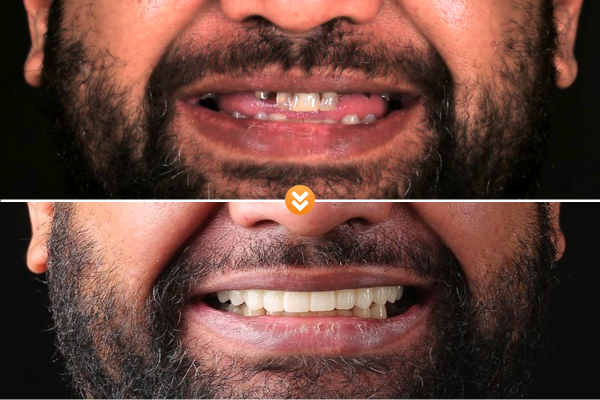 A patient before and after receiving a temporary full-arch prosthesis. Photos courtesy of Dr. Care Implant Clinic