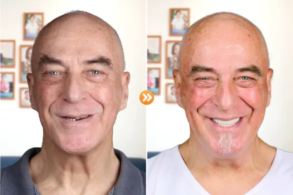 An international patient before (L) and after (R) treatment at the clinic. Photo courtesy of Dr. Care Implant Clinic