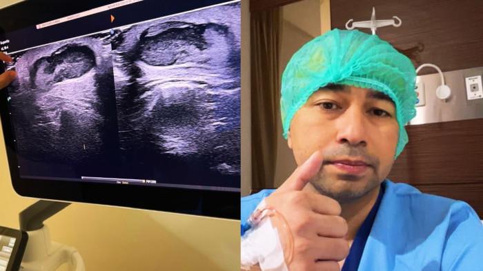 KONDISI BENJOLAN - Kolase hasil rontgen dan potret Raffi Ahmad kala berada di rumah sakit, dicapture Rabu (3/6/2026). 