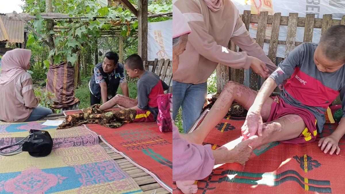 Tiga santri di pondok pesantren di Desa Mantang Lombok Tengah jadi korban pembakaran diduga dilakukan kakak kelas hingga 1 anak tewas.Kondisi Sahid Al Hudry (13) santri salah satu pondok pesantren di Lombok Tengah yang mengalami luka bakar.(KOMPAS.COMKARNIA SEPTIA KUSUMANINGRUM)