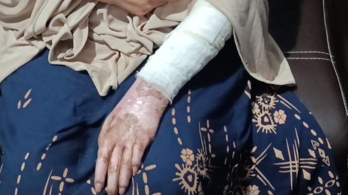 LUKA BAKAR - Kondisi luka yang dialami MAN (30), perempuan asal Kota Cirebon yang menjadi korban penganiayaan dan kekerasan oleh oknum polisi Polres Tegal Kota yang juga suami sirinya.