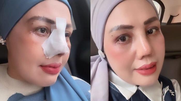 OPERASI HIDUNG -- Elly Sugigi menuai komentar negatif netizen setelah melakukan prosedur operasi plastik hidung (rhinoplasty) di RS Triadipa Jakarta demi mempercantik diri.