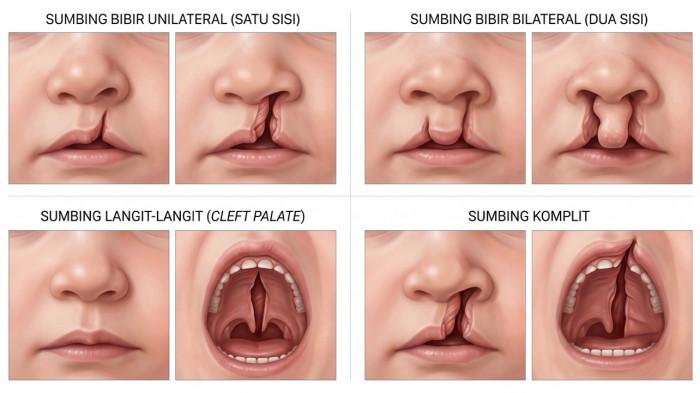 ILUSTRASI- Kategori Tipe Bibir Sumbing dan Langit-langit. Mengetahui tipe celah secara dini sangat penting untuk merencanakan tahapan operasi yang tepat.