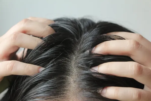 Close-up of a person scratching their oily, dandruff-covered scalp.