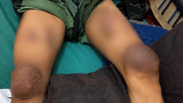 LUKA BAKAR - Adzan, pekerja asal Tanjung Jabung Timur, mengaku mengalami luka bakar serius saat lembur di pabrik kayu pelet di Kampar.Tangis sang ibu bernama Linda pecah saat menceritakan kondisi Adzan yang mengalami luka bakar dan cacat permanen.