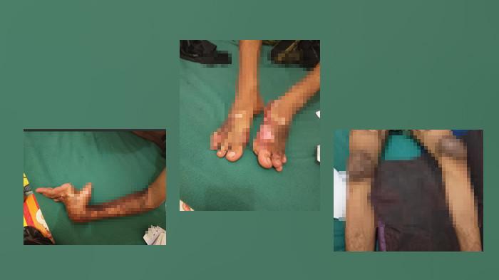 KECELAKAAN KERJA - Seorang warga Jambi pada Rabu (8/8/2026) mengadukan kondisinya setelah diduga menjadi korban kecelakaan kerja di sebuah perusahaan Riau. Peristiwa nahas itu terjadi hampir dua tahun lalu, tepatnya 5 September 2024.