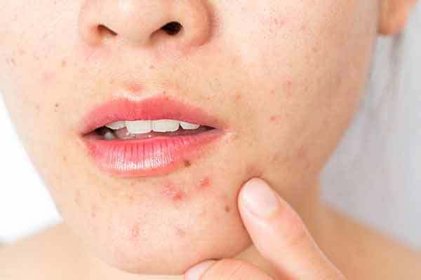 Acne after makeup? Mira Kapoor reveals 3 common skincare mistakes